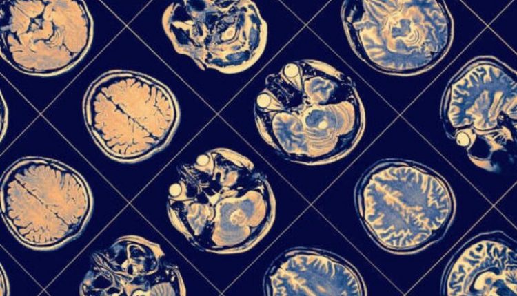 AI and machine learning facilitate pioneering research on Parkinson’s